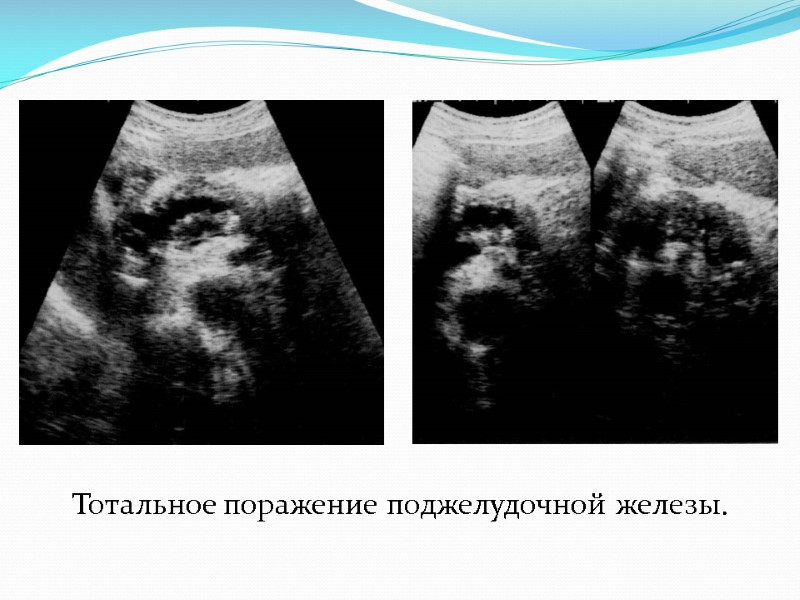 Тотальное поражение поджелудочной железы.